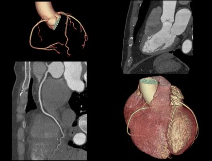 Muss es immer ein Herzkatheter sein? Herz-CT als Alternative